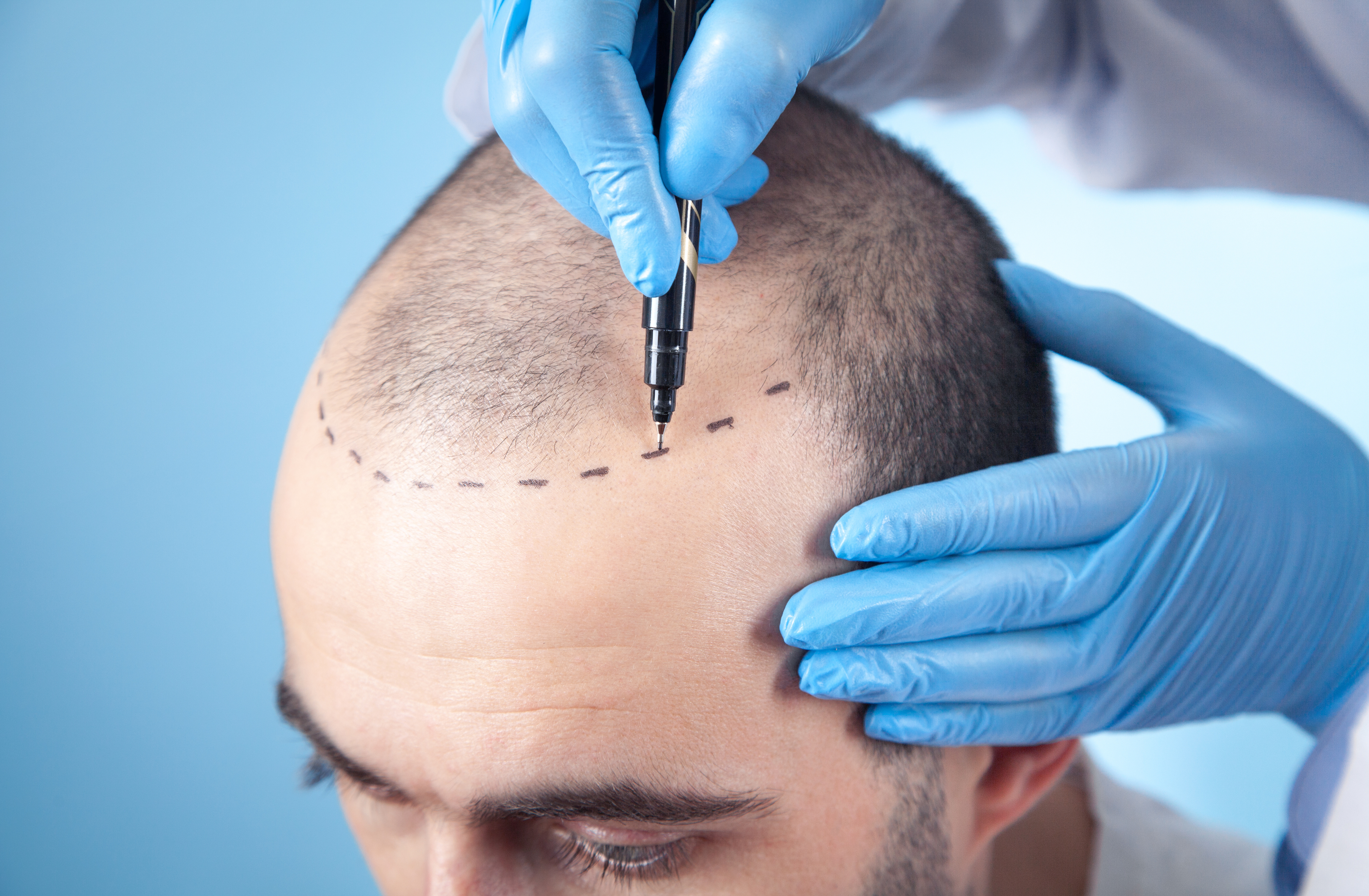 hair-transplant hero item 1